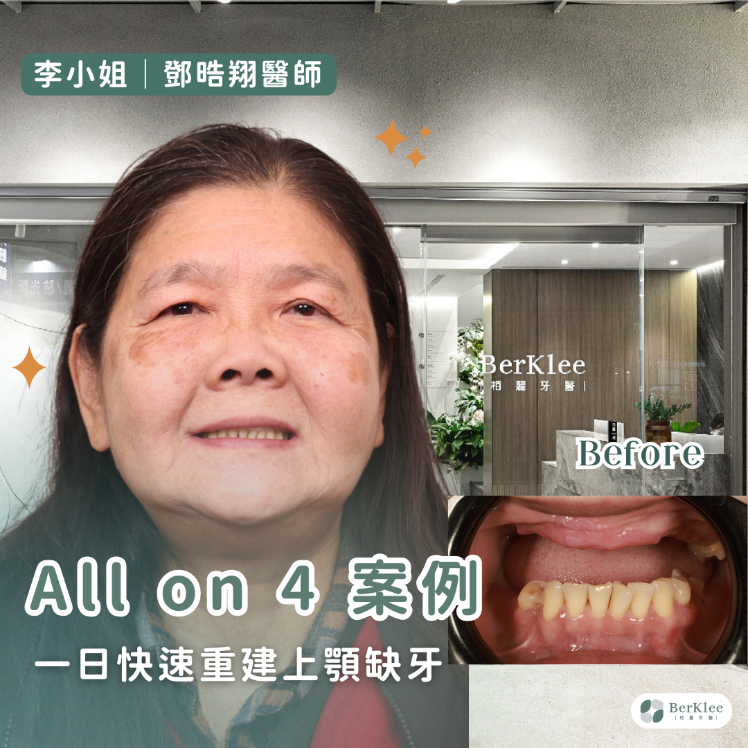 All on 4 桃園上顎植牙案例－李小姐告別上排牙齒全失困擾，一日快速恢復咀嚼功能！