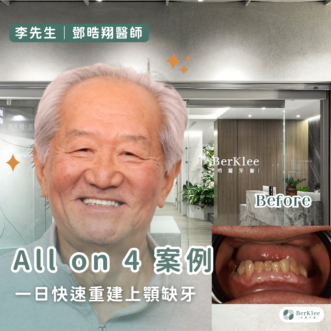 桃園 All on 4 上顎植牙案例－銀髮族也能植牙嗎？一日快速全口重建，助李先生重返年輕笑容！
