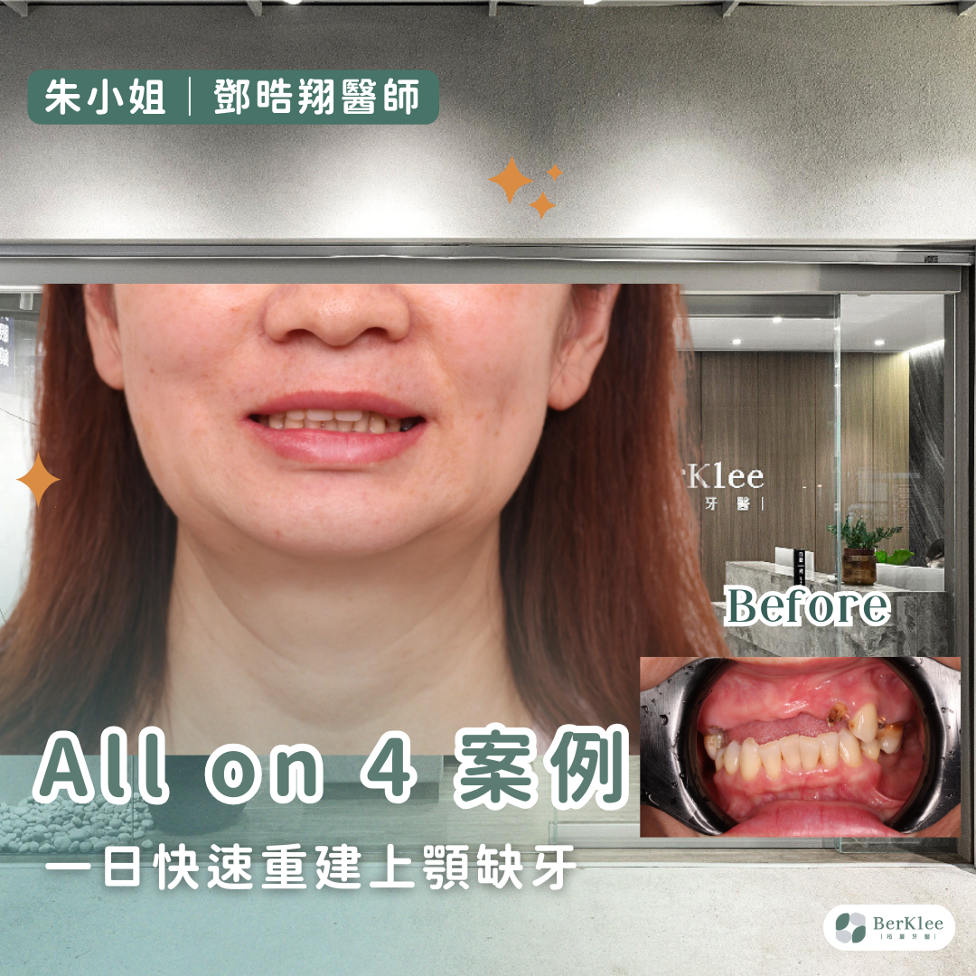 桃園 All on 4 上顎植牙案例－朱小姐一日全口重建，找回美麗燦爛笑容！