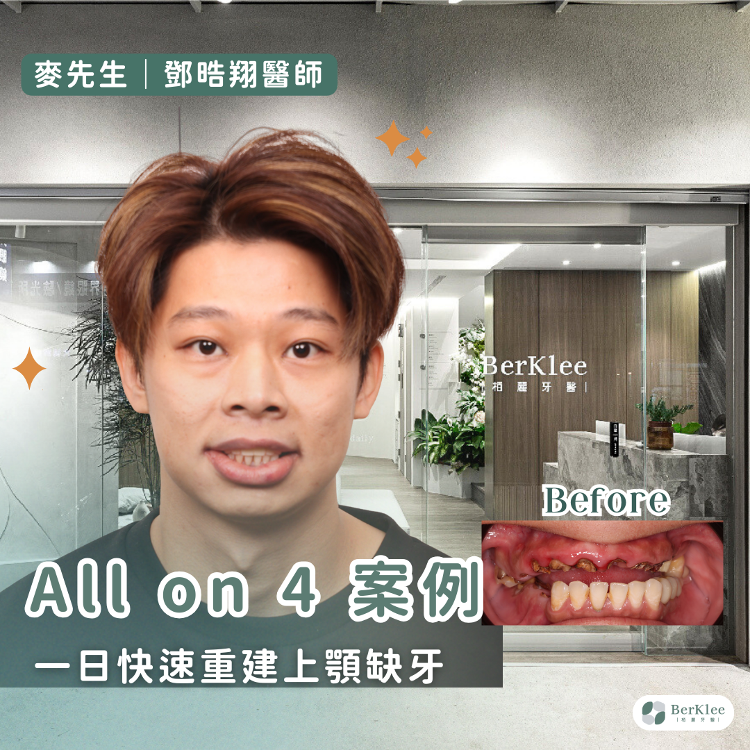 桃園 All on 4 上顎植牙案例－麥先生上排牙齒嚴重缺失，一日全口重建，恢復咀嚼功能！