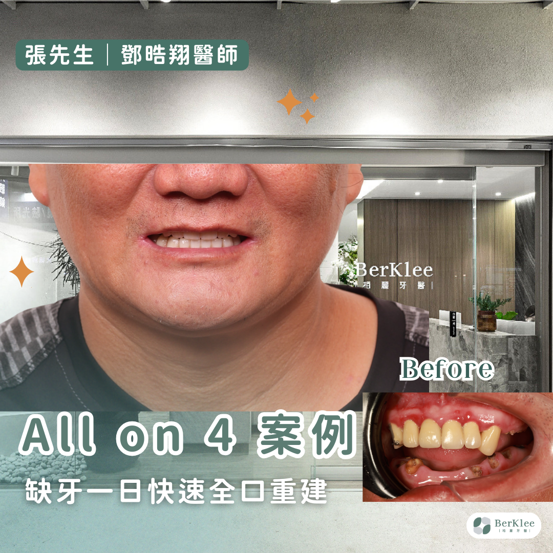 桃園 All on 4 全口重建案例－張先生下排牙齒嚴重缺失，舒眠麻醉一日重建新牙！