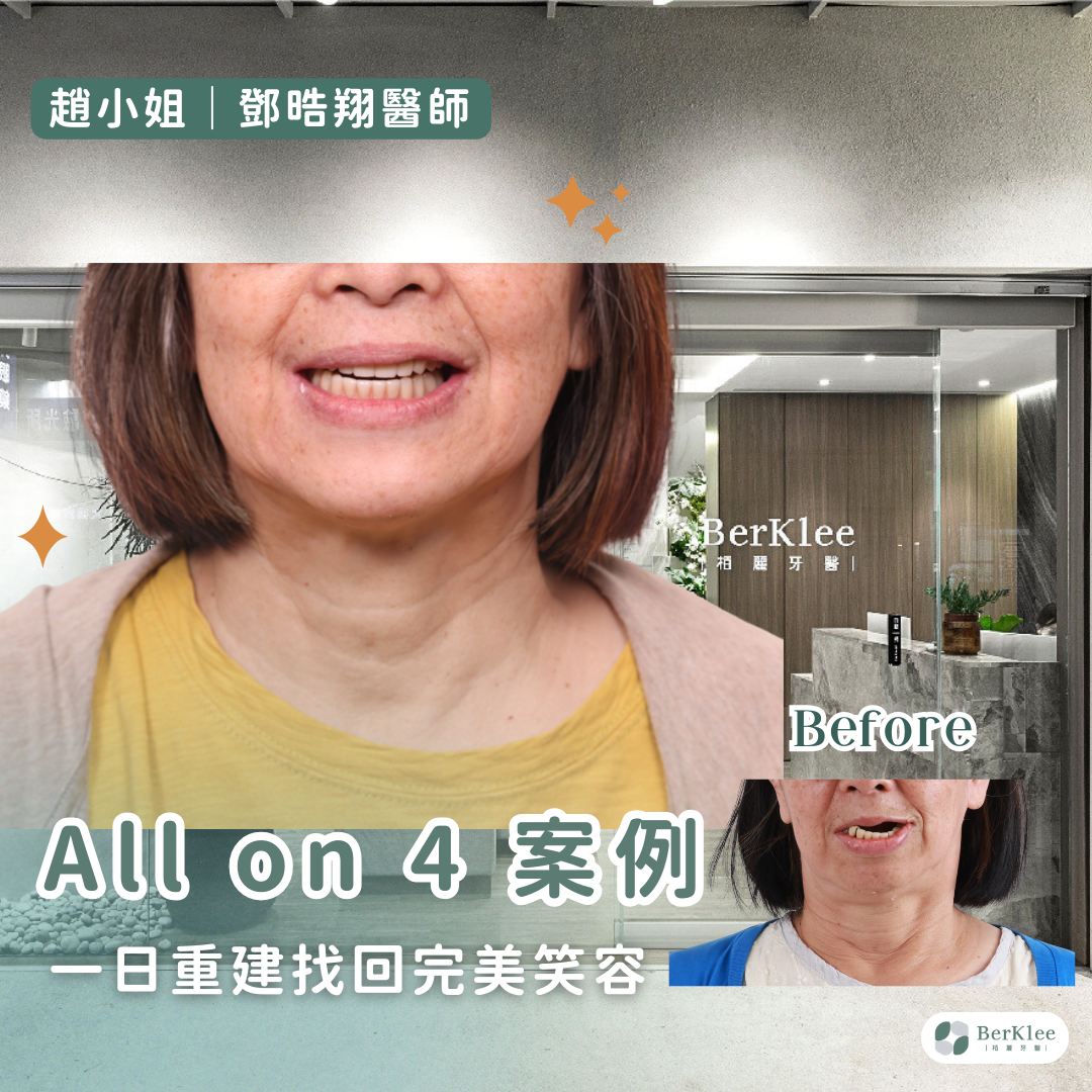 桃園 All on 4 全口重建案例－趙小姐一日全口重建，矯正牙齒，找回美麗笑容！