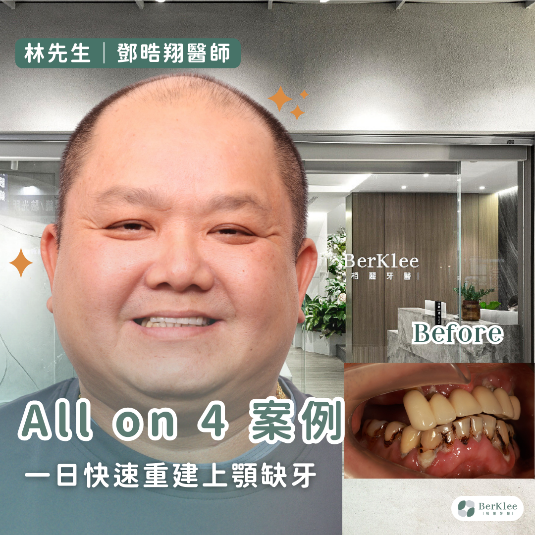 桃園 All on 4 上顎植牙案例－林先生嚼檳榔也能植牙嗎？一日快速全口重建找回健康笑容！