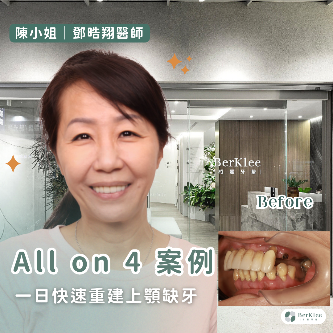 桃園 All on 4 上顎植牙案例－助陳小姐一日快速重建，亮白整齊新牙！