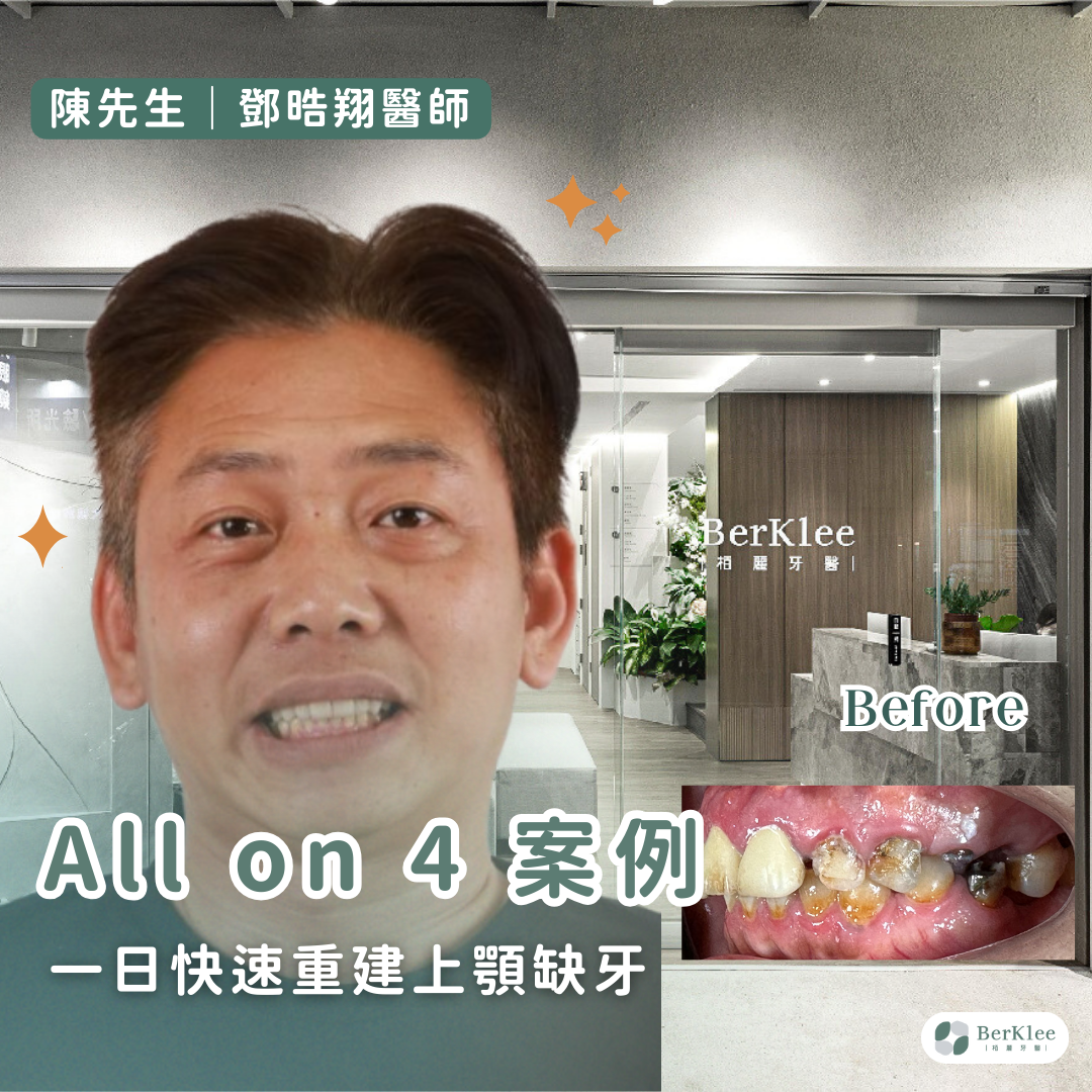 桃園 All on 4 上顎植牙案例－助陳先生擺脫牙齒發黑，缺牙咀嚼困難，一日獲得嶄新好牙！
