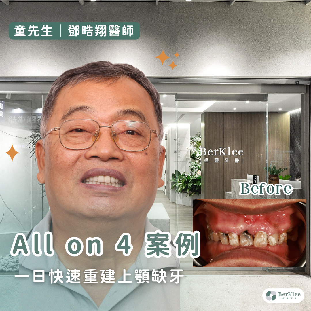 桃園 All on 4 上顎植牙案例－助童先生擺脫牙齒發黑，一日重建自然白皙牙齒，笑容更燦爛！