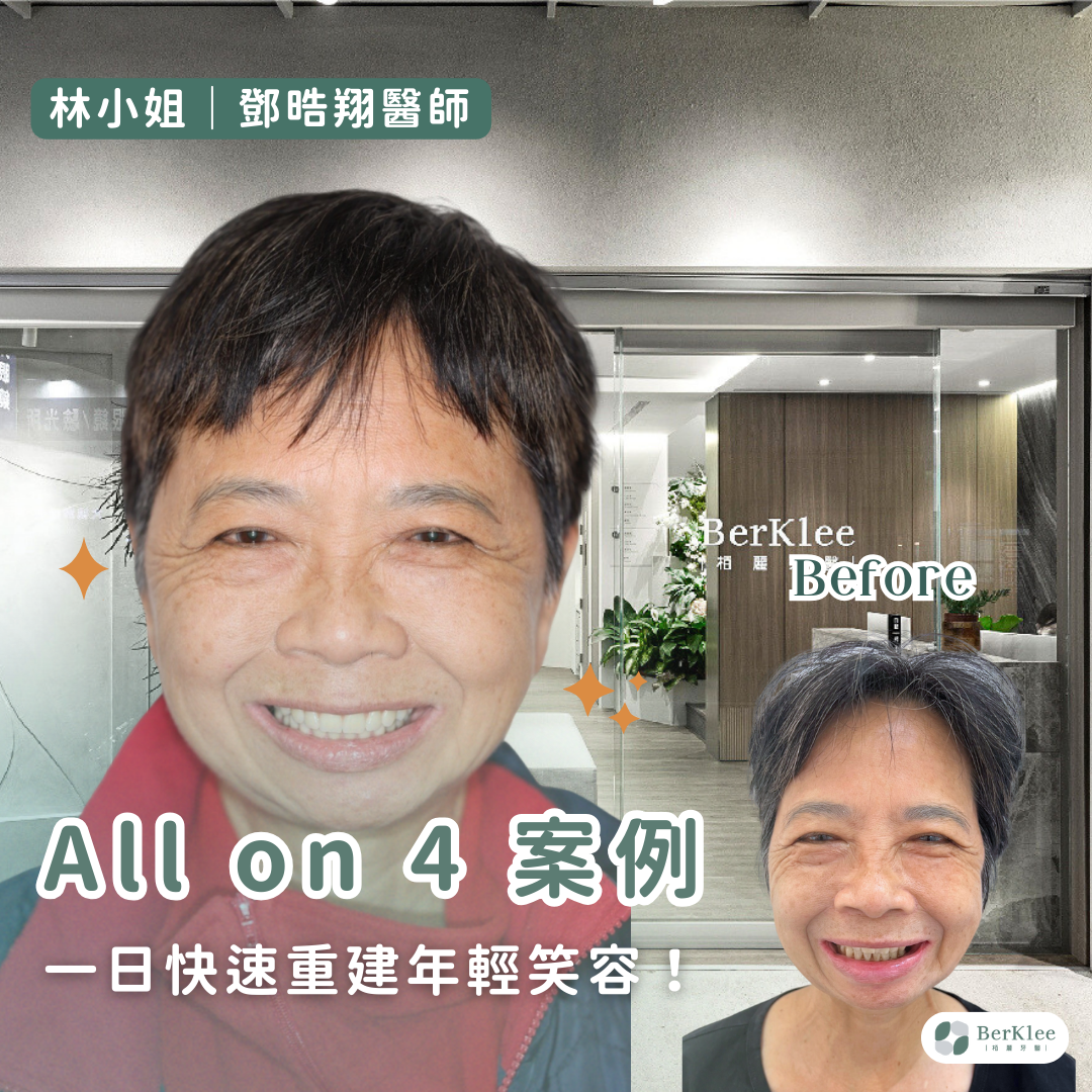All on 4 桃園全口重建案例－林小姐一日快速全口重建，找回年輕自信笑容！