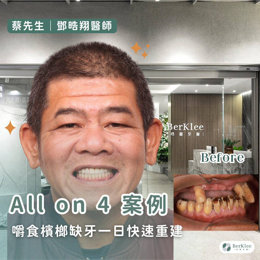 桃園 All on 4 全口重建植牙案例－助蔡先生擺脫嚼食檳榔缺牙泛黃，一日綻放健康笑容！