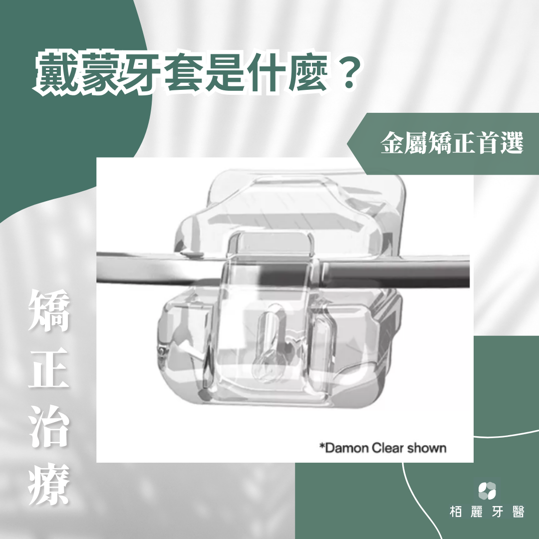 桃園專業牙齒矯正｜戴蒙牙套、自鎖矯正和傳統矯正的區別與選擇指南