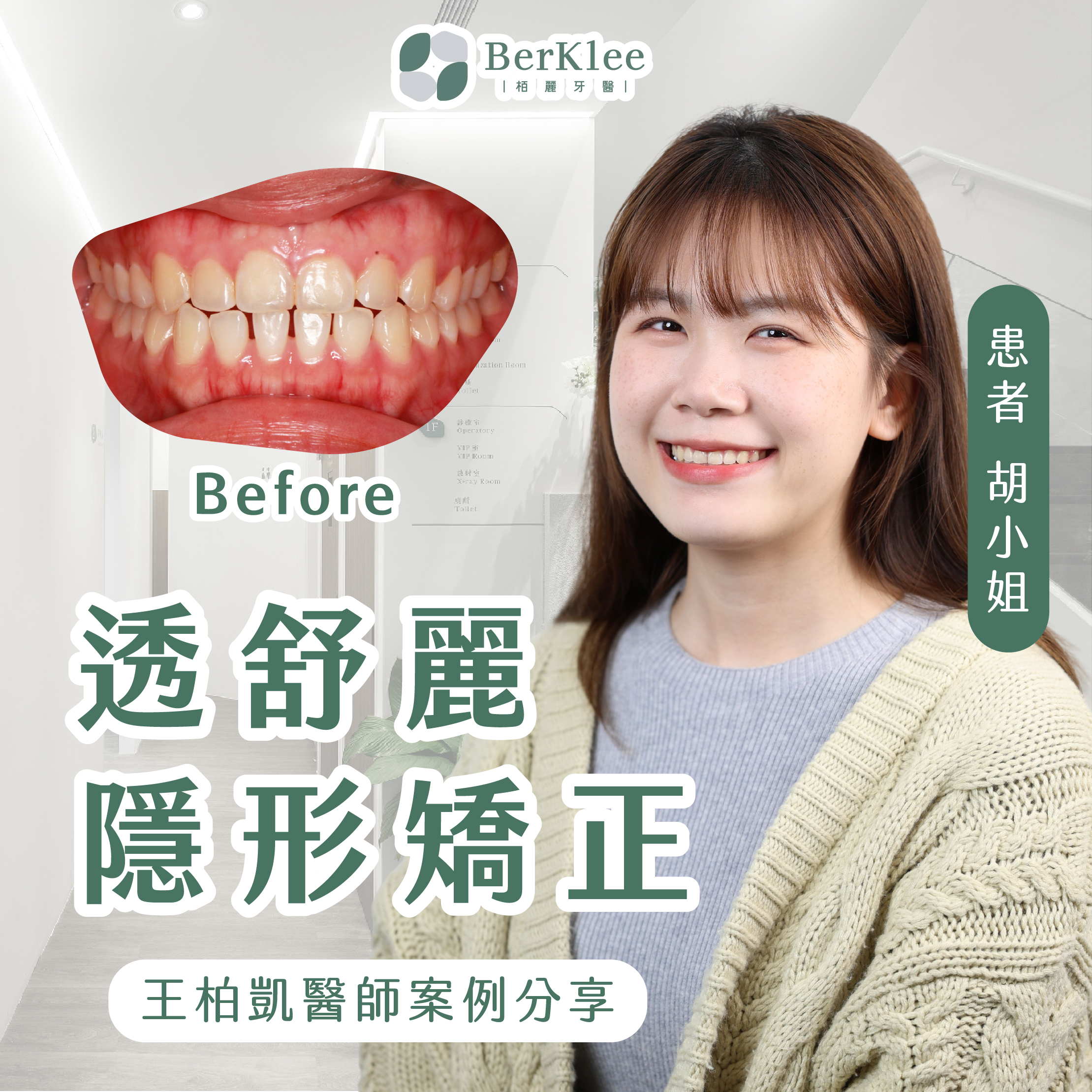 隱形矯正案例｜二次矯正成功！揭密胡小姐如何重拾笑容，為何矯正後戴維持器如此重要？