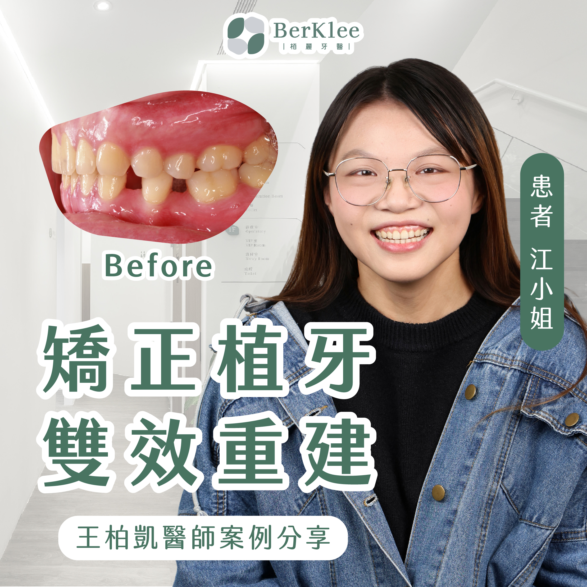 隱形矯正案例｜牙縫鬆散竟是先天缺牙惹的禍！透舒麗隱形矯正 + 植牙修復案例