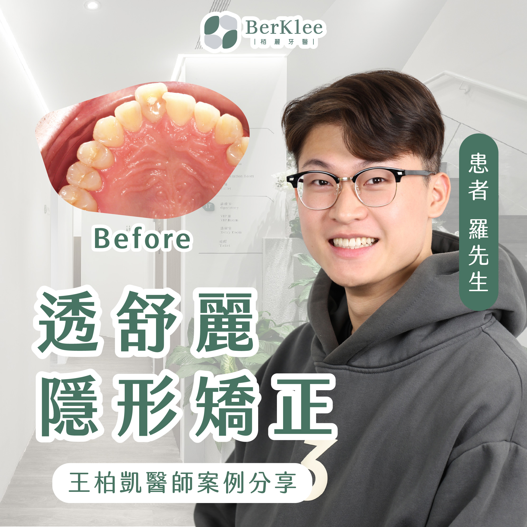 隱形矯正案例｜25歲羅先生門牙外凸，透舒麗隱形矯正一年內恢復整齊牙齒！