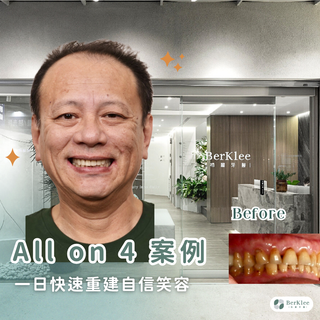 All on 4 全口重建案例｜檳榔磨牙咬合異常，使用 Nobel 植牙全面修復！