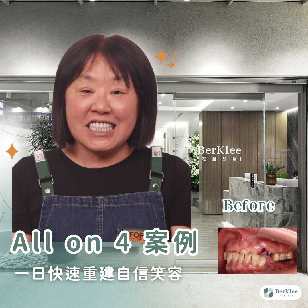All on 4 全口重建案例｜台商口腔重建：針對長期牙周病咬合問題，實現一日全口重建！