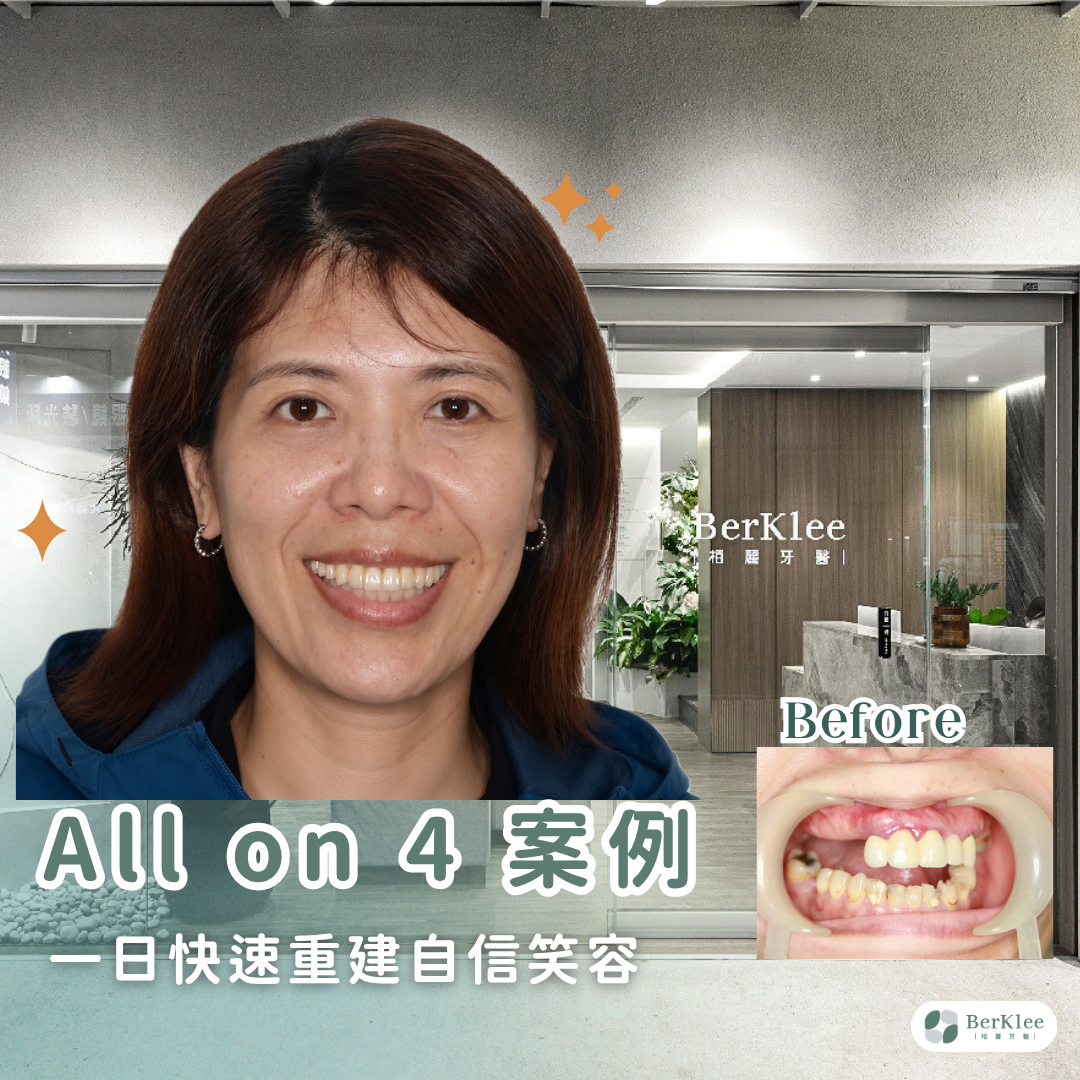 All on 4 全口重建案例｜十年牙科恐懼者全口重建，舒眠植牙搭配全瓷冠煥新齒貌