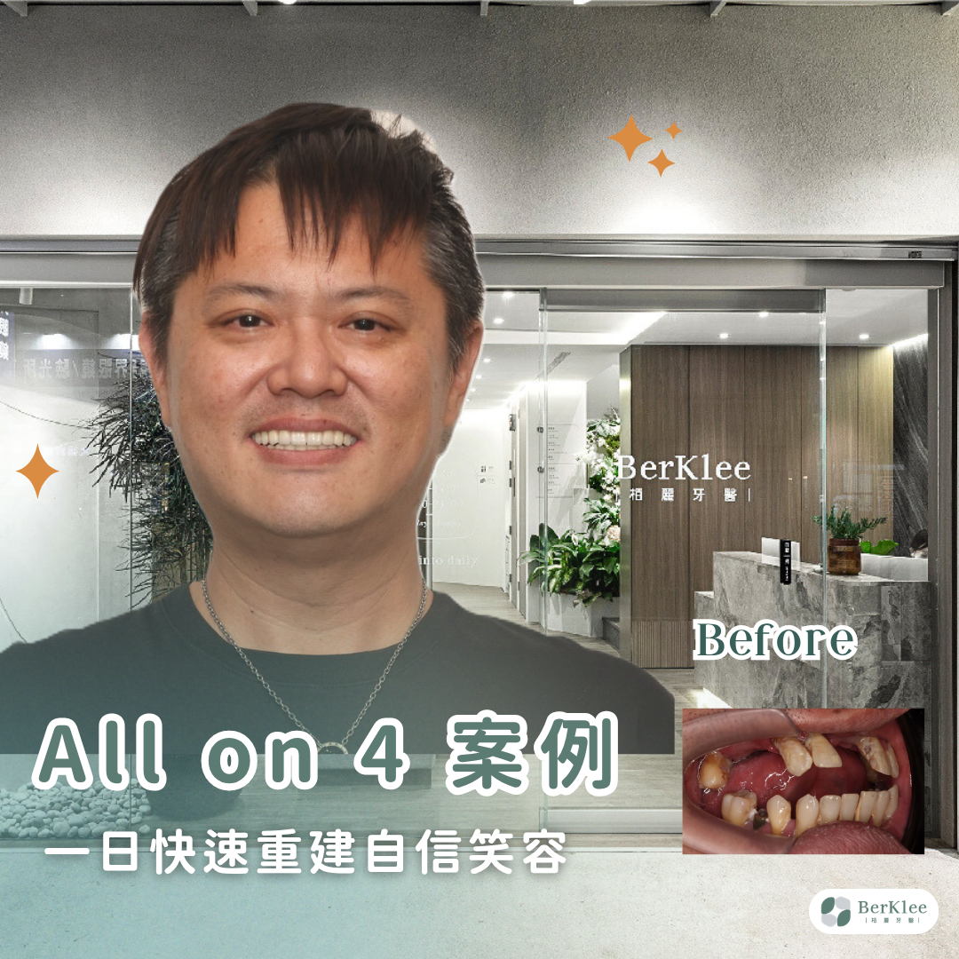 All on 4 全口重建案例｜4D 導航精準手術，室內設計師門牙阻生齒處理、補骨順利完成！