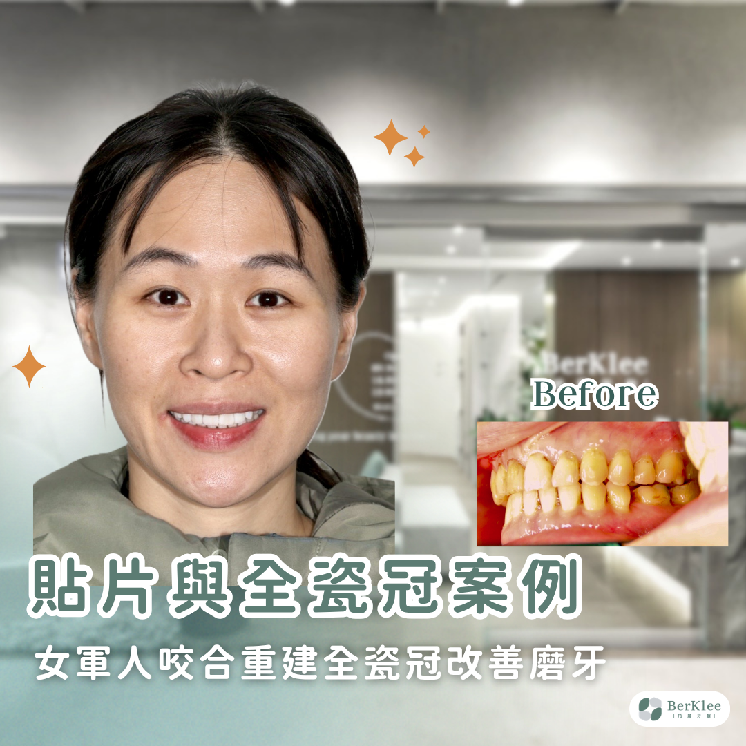 全瓷冠及瓷牙貼片案例｜磨牙導致牙酸敏感、顳顎關節緊繃怎麼改善？