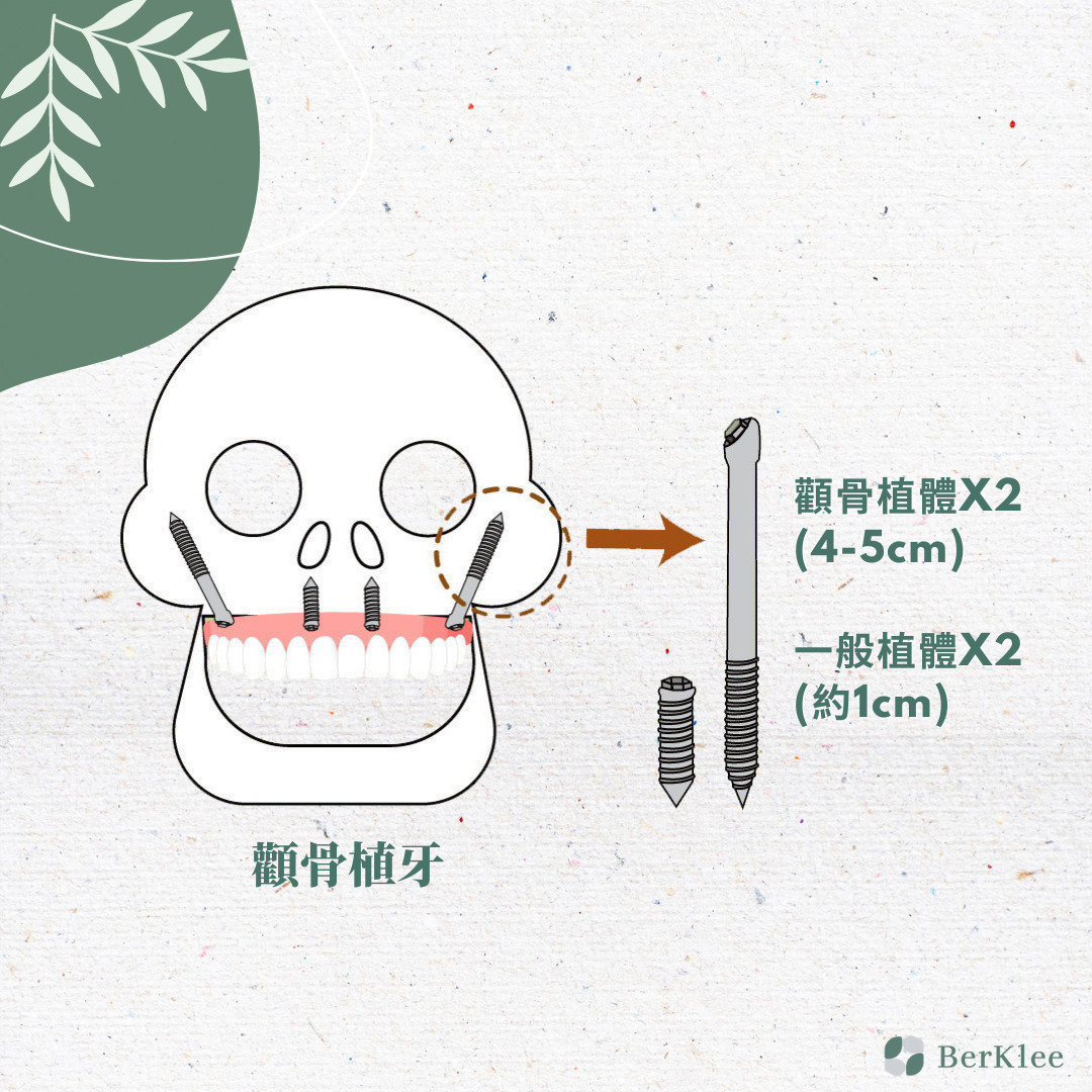 顴骨植牙－骨量不足的植牙推薦，牙齒重建不再擔心補骨問題！